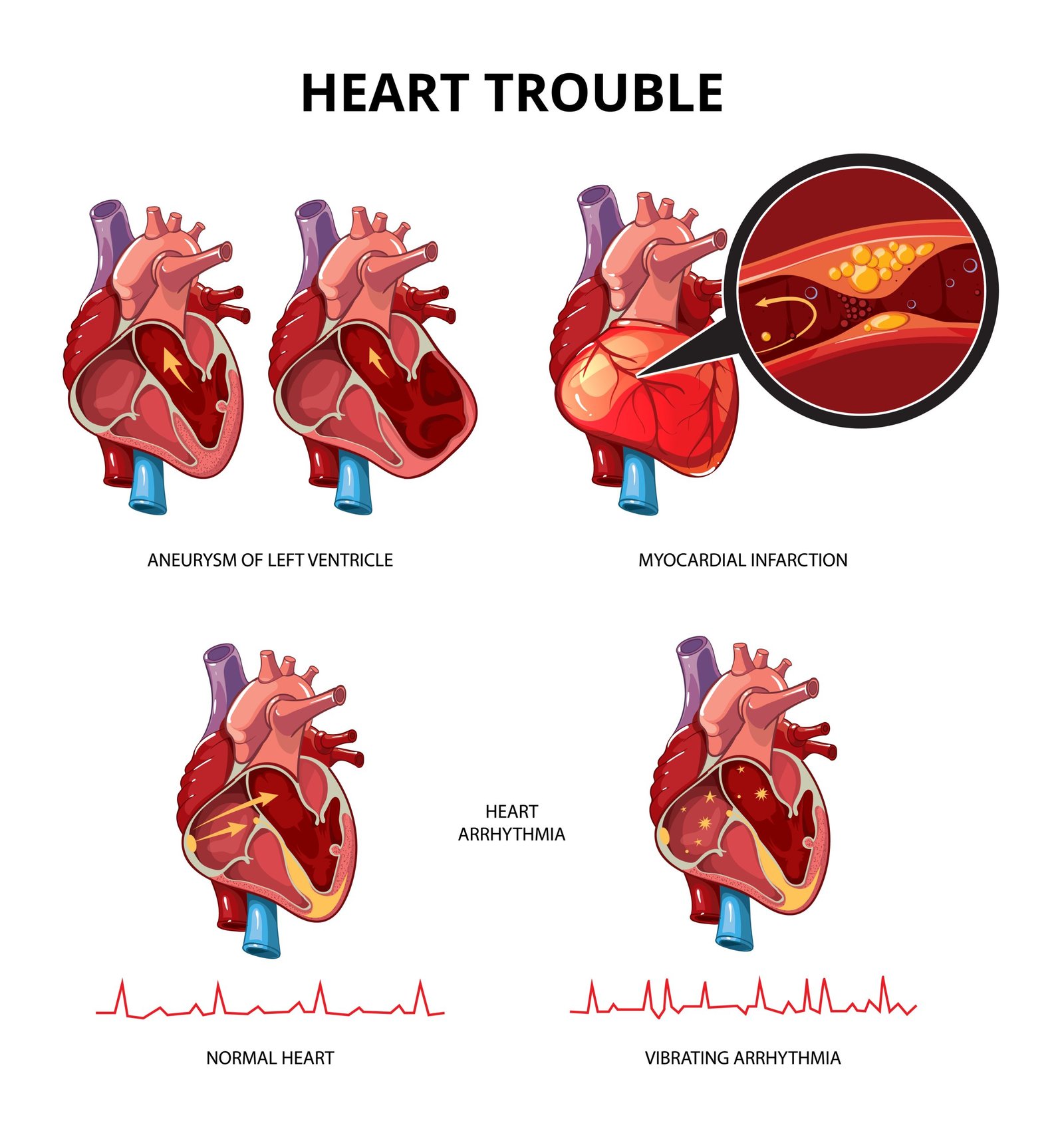 isw-heart-problem