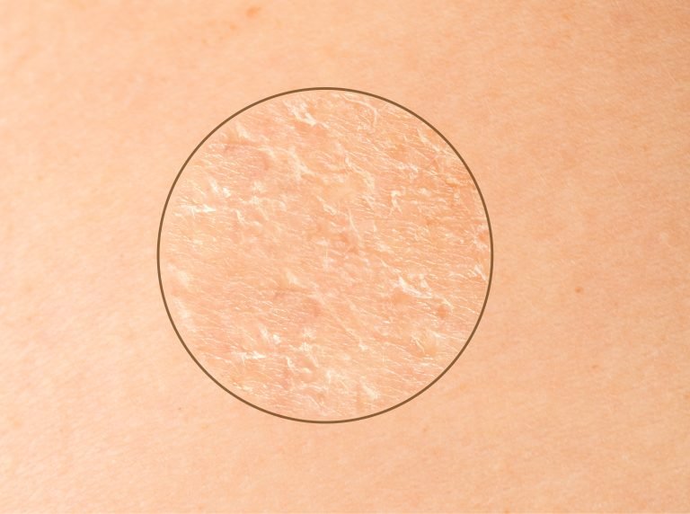 isw-dry-skin