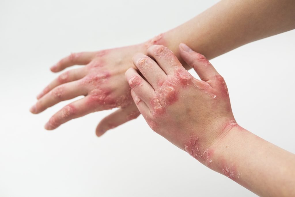 isw-eczema